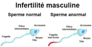 Pourquoi l'infertilité masculine