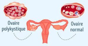 traitement des kystes ovariens