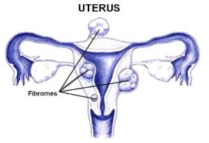 traitement des fibromes utérins