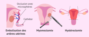 Myomectomie