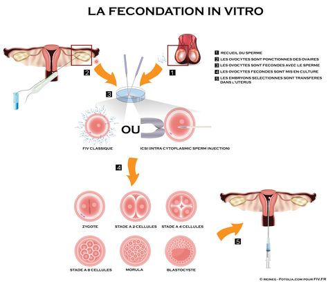 les étapes de la fécondation in vitro