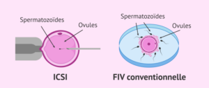 les étapes de la fécondation in vitro