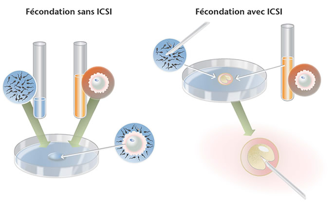 APRES LA FECONDATION IN VITRO