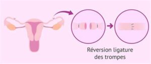 fécondation in vitro après ligature de trompes