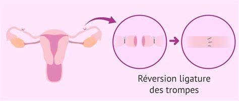 fécondation in vitro après ligature de trompes