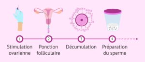 FECONDATION IN VITRO ICSI