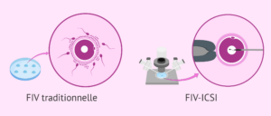 fécondation in vitro icsi