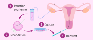 fécondation in vitro après ligatures de trompes