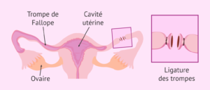 fécondation in vitro après ligature de trompes