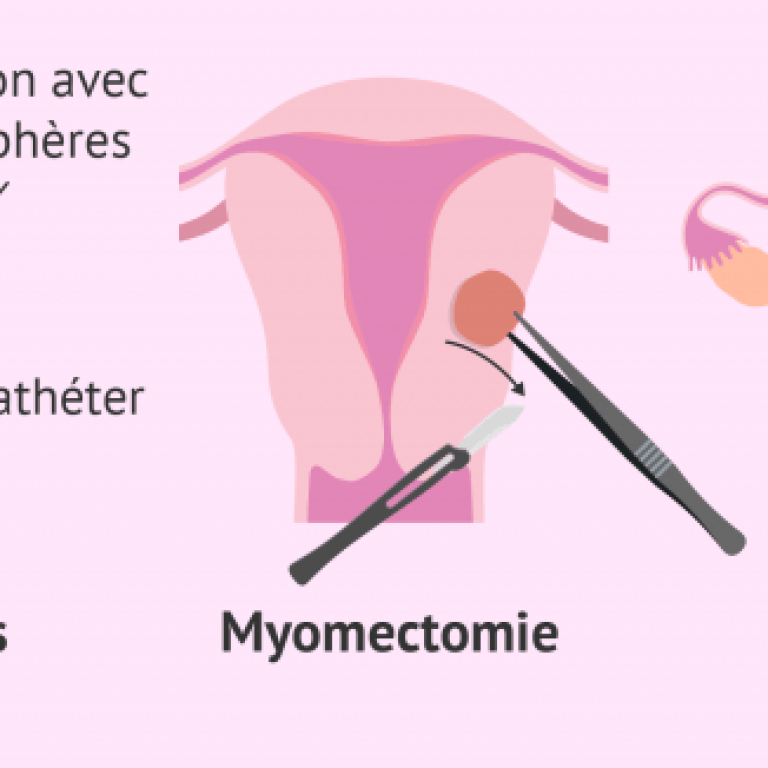 traitement-des-fibromes-768x326-1